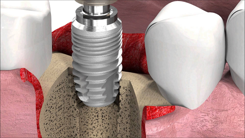 Trồng răng bằng Implant nướu bị đỏ