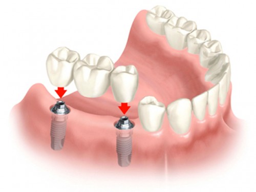 Trung tâm nha khoa cấy ghép răng – implant uy tín, chất lượng tại TpHCM