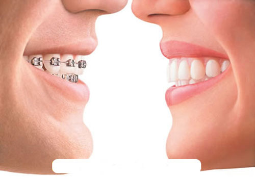 Các yếu tố cần thiết cho quá trình niềng răng hiện nay