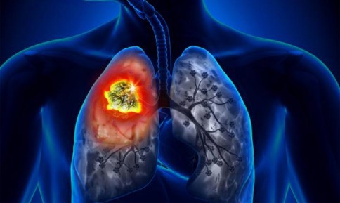 Những dấu hiệu chứng tỏ bạn đang bị ung thư phổi