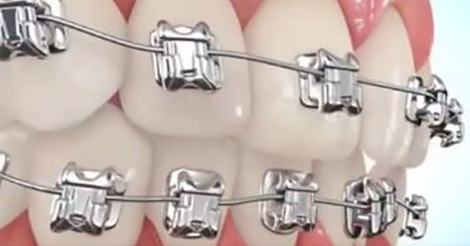 Quá trình thay đổi của hàm răng khi sử dụng niềng răng