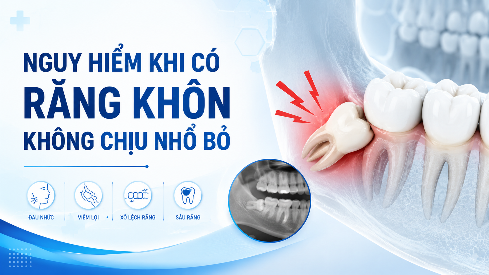 Nguy hiểm khi có răng khôn không chịu nhổ bỏ
